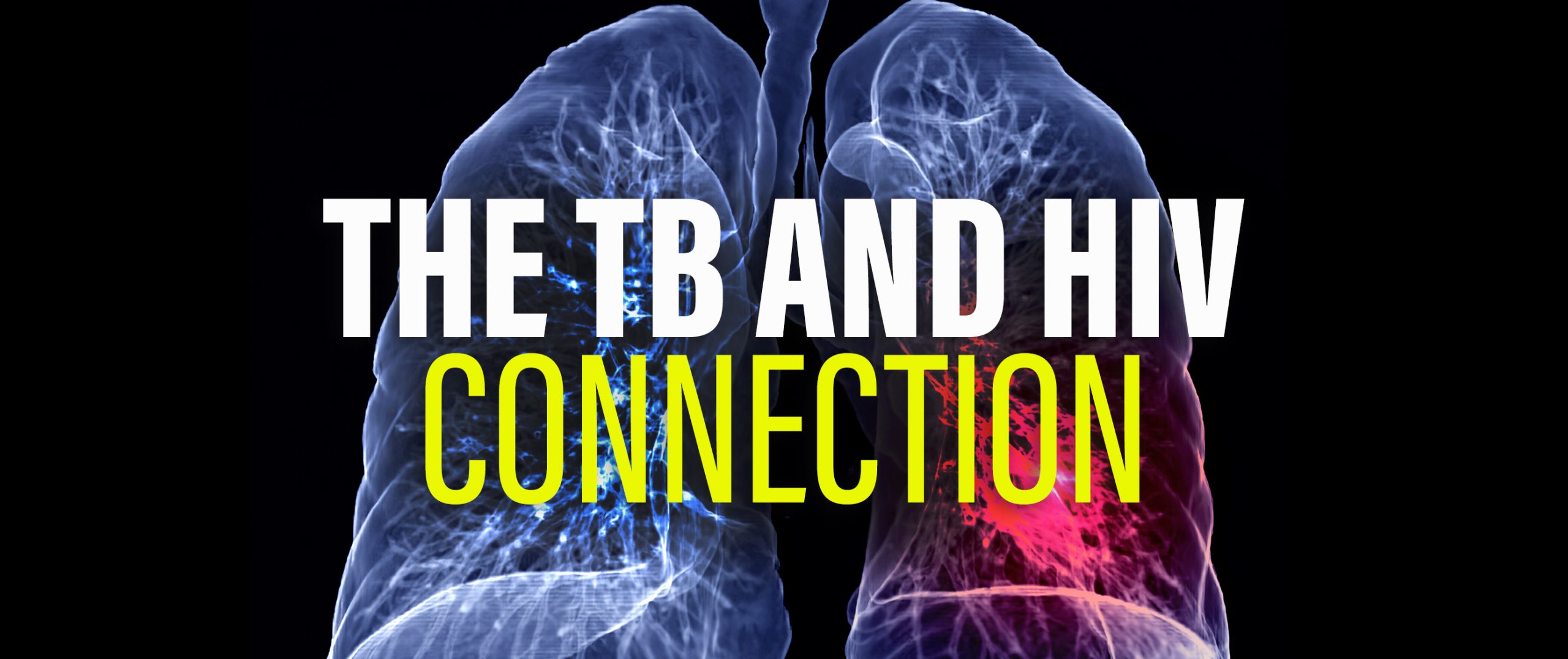 The TB And HIV Connection